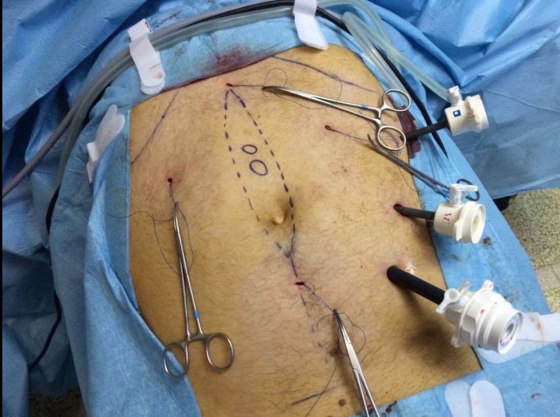 laparoskopowa naprawa przepukliny powyżej pępka w linii pośrodkowej ciała