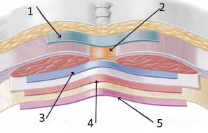 w zależności od metody operacyjnej siatka przy naprawie przepukliny może być wprowadzona do różnych warstw ściany brzucha (1-5)